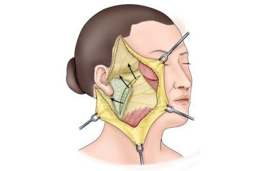 发际耳后切口拉皮手术示意图 发际耳后切口拉皮手术示意图
