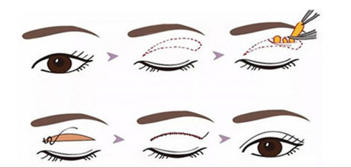 全切双眼皮过程示意图