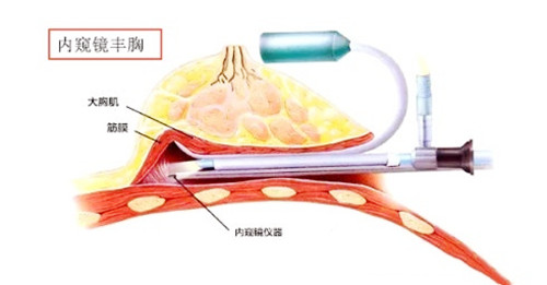 丰胸卡通图.jpg 丰胸卡通图.jpg
