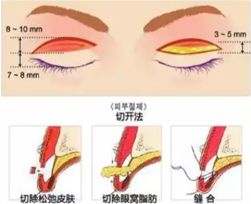 切开双眼皮手术 切开双眼皮手术
