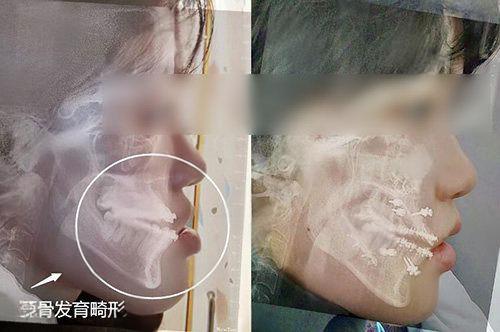 毕节近视手术价格大揭秘！从千元到万元，哪种适合你？