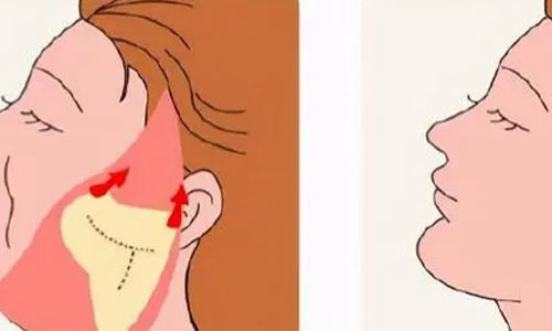 隋冰医生拉皮多少钱？术式/松弛程度/联合项目价格影响因素