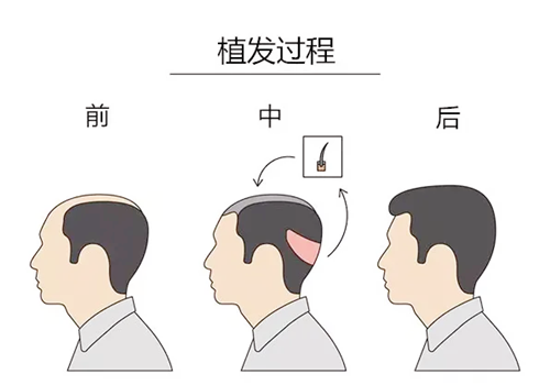 植发过程图示.png