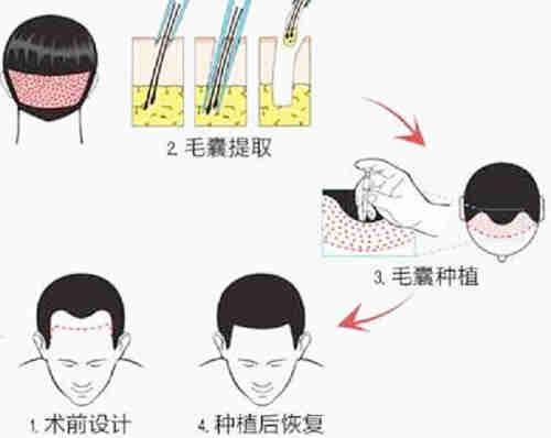 2025年爱尔眼科近视手术价格大揭秘！这份价目表请收好