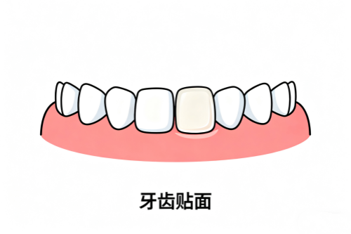 牙齿贴面卡通展示图
