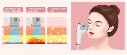 合肥超声炮医院指南：正规机构与透明价格一览