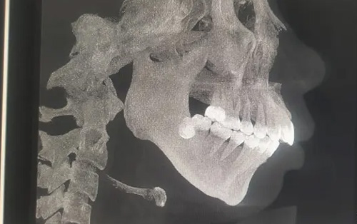 星趣控眼镜3980元贵不贵？深度解析价格表与近视手术对比