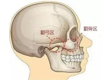 颧骨缩小针有效吗？揭秘不开刀缩颧骨的一针降颧骨骗局！
