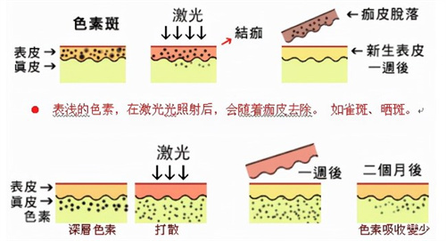 深圳皮秒激光哪家强？综合医院盘点+价格指南