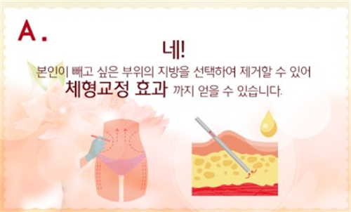 整形日记：爱婷吴珉脂肪填充手术3个月重回照片全记录