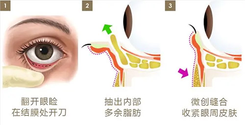 珠海祛眼袋整形医院前三强盘点，技术娴熟不留疤的秘密在这里