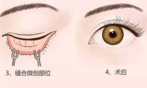 珠海祛眼袋去哪里好？这份避坑指南请收好
