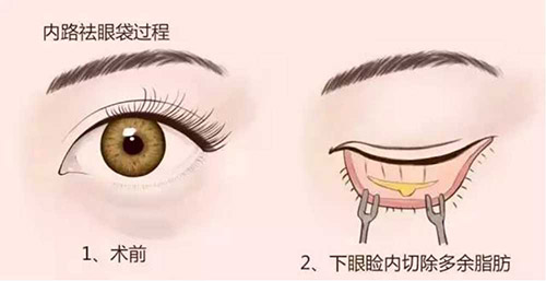 珠海祛眼袋整形医院哪家强？前******技术PK，不留疤才是真本事