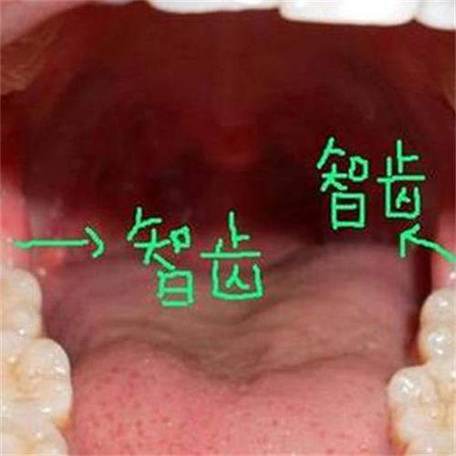 毕节拔智齿多少钱一颗？附拔智齿技术比较好的医院+地址！