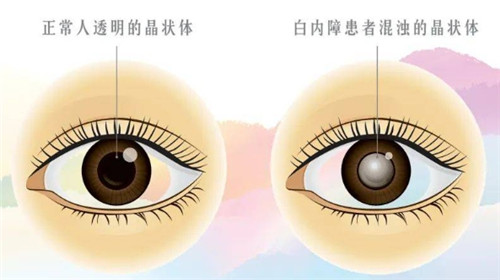 英国瑞纳人工晶体怎么样好不好？RAYNER人工晶体特点、价格、材料、优势全解析！白内障手术必看指南