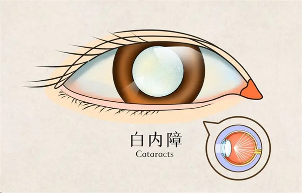 2025白内障人工晶体价格指南：较新价目表与选择攻略