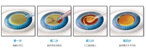 2025年爱尔眼科手术费用全解析：近视/斜视/白内障/青光眼价格指南
