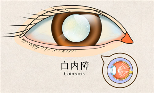 2025年***白内障晶体报销吗？更新政策解读：手术费用能省一大笔！