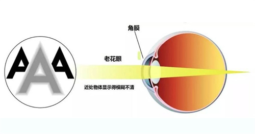 2025年白内障免费政策来了！60/70/80岁老人速看，***报销+手术全攻略