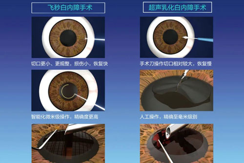 2025爱尔眼科手术价目表新鲜出炉！近视/白内障/青光眼/OK镜价格全解析