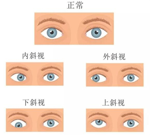 深圳斜视手术医院怎么选？这份避坑指南请收好