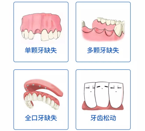 重庆万州种植牙哪里做的好？价格要多少钱一颗？看这篇超全攻略！