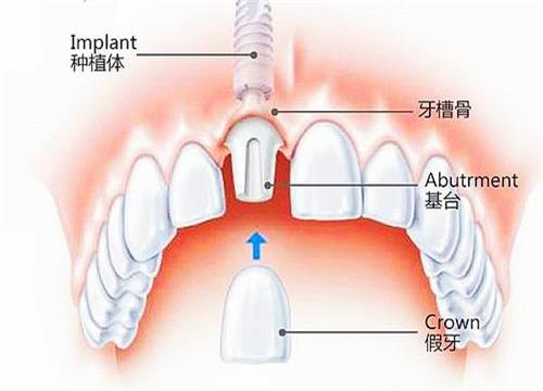 种植牙法国安卓健好吗？详解安卓健种植体型号和特点！