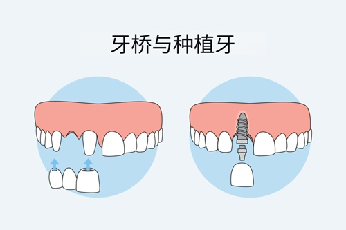 北京五棵松附近种植牙哪家便宜又好？锁定这4大牙科性价比高