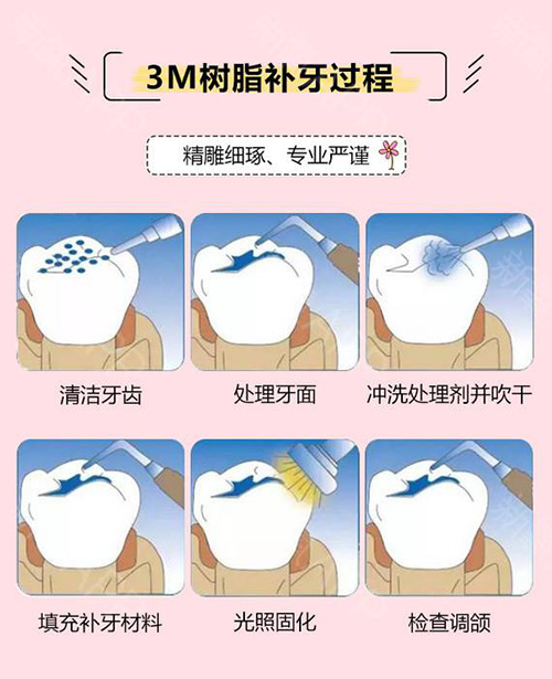 3M树脂补牙过程.jpg